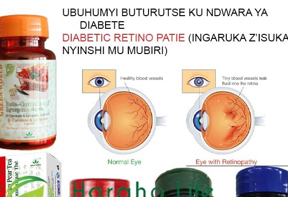 <a style='color:#ffffff;' href='spip.php?page=article&id_article=411'>UBUHUMYI BUTURUTSE KU NDWARA YA DIABETE/ DIABETIC RETINO PATIE (INGARUKA Z’ISUKARI NYINSHI MU MUBIRI)</a>